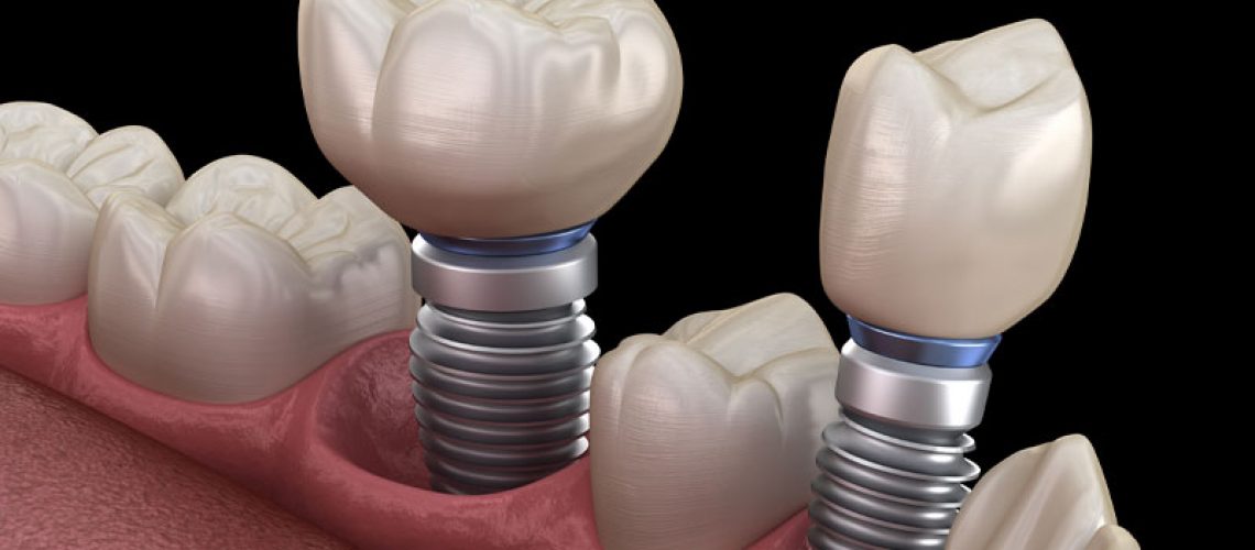 Dental Implant Model