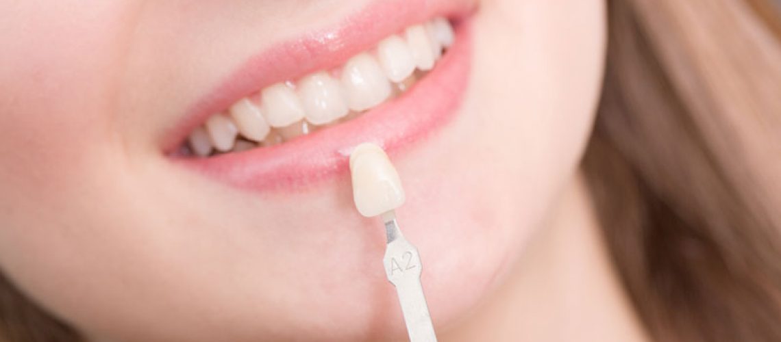 Dental Veneers Patient