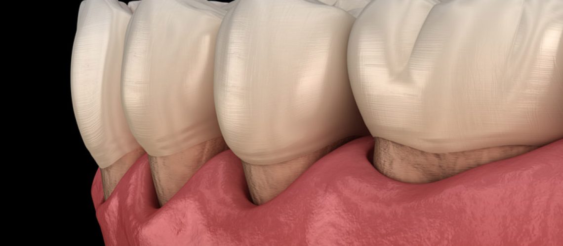 Gum Recession Close Up Graphic